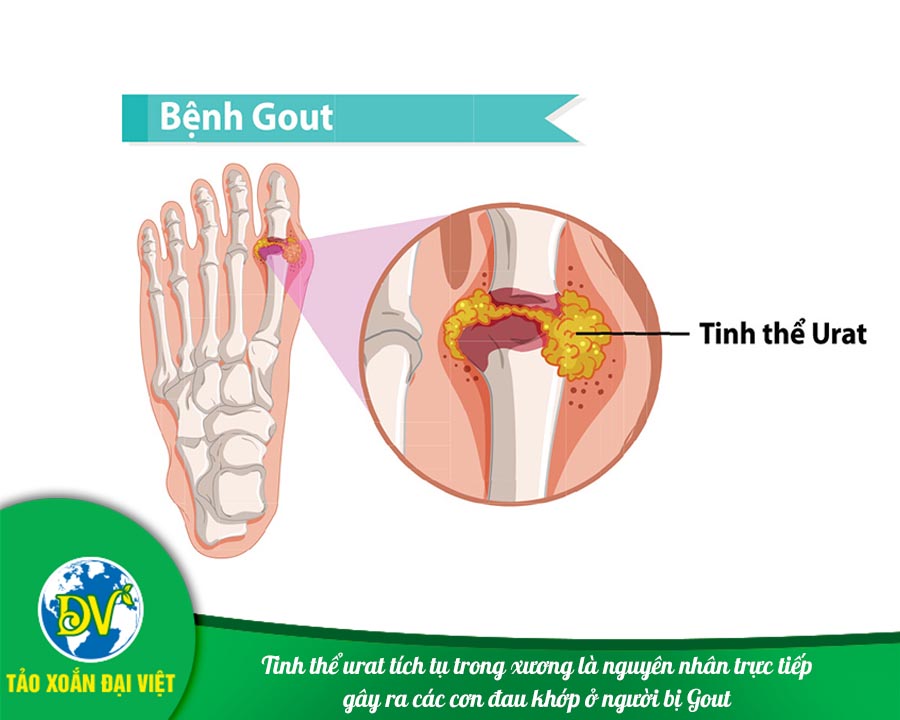 Tinh thể urat tích tụ trong xương là nguyên nhân trực tiếp gây ra các cơn đau khớp ở người bị Gout
