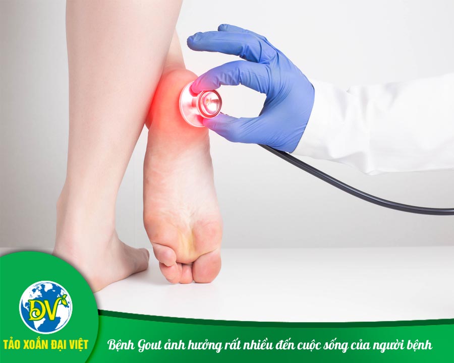 Bệnh Gout ảnh hưởng rất nhiều đến cuộc sống của người bệnh