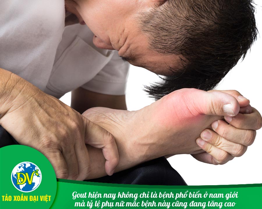 Gout không chỉ là bệnh phổ biến ở nam giới mà tỷ lệ phụ nữ mắc bệnh này cũng đang tăng cao
