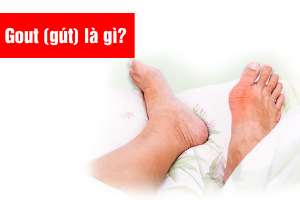 Gout (gút) là gì?| Nguyên nhân, triệu chứng và điều trị