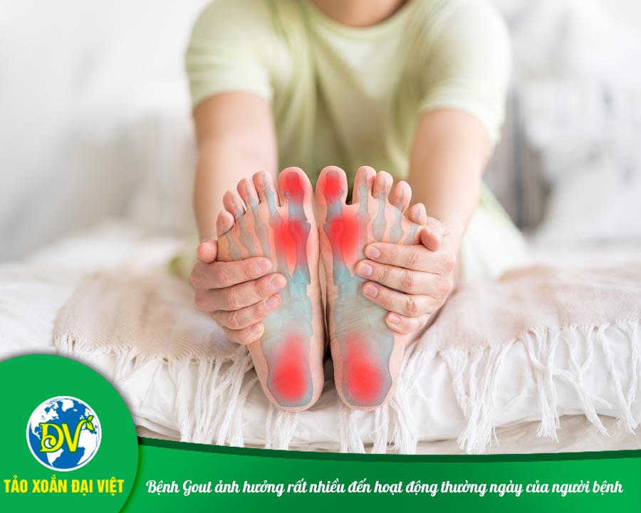 Bệnh Gout ảnh hưởng rất nhiều đến hoạt động thường ngày của người bệnh