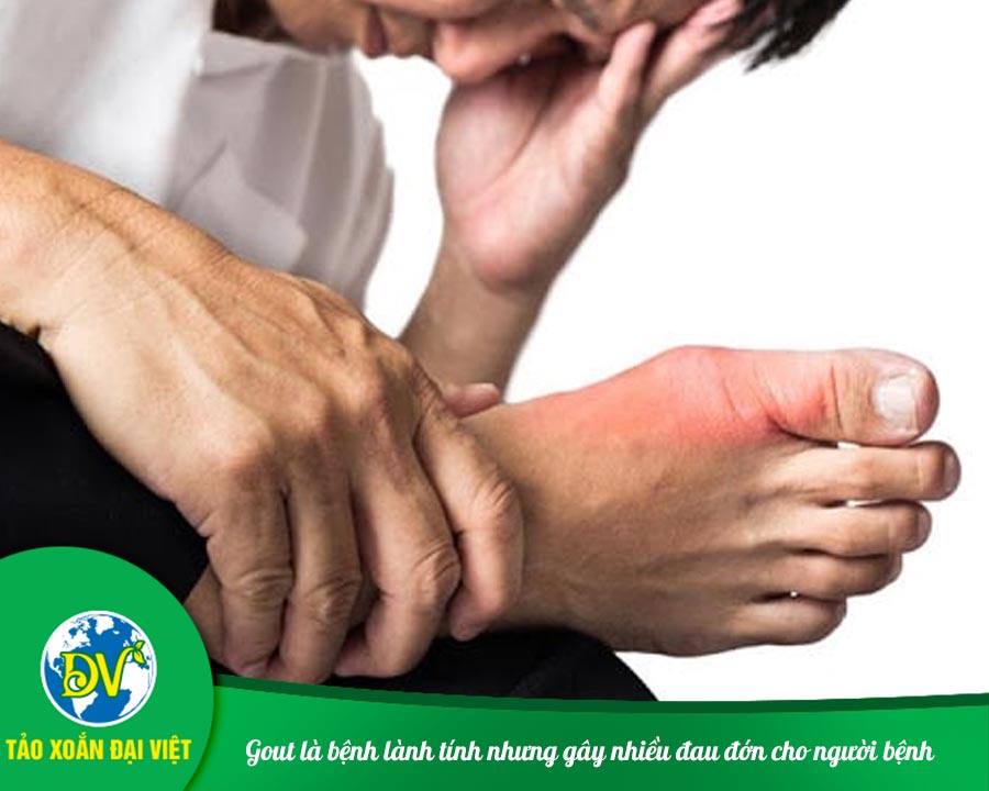 Gout là bệnh lành tính nhưng gây nhiều đau đớn cho người bệnh