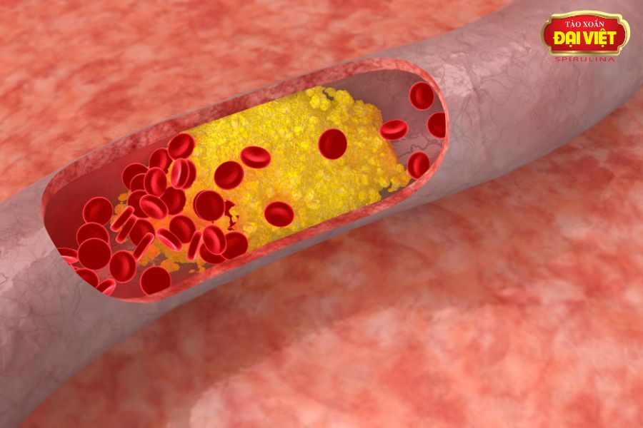 Tảo xoắn tác động làm giảm hàm lượng Triglycerid, Cholesterol